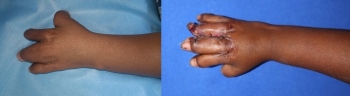 Life-altering surgery at KLES Hospital for child born with syndactyly