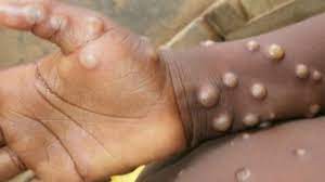 Monkeypox scare: Is Goa's health sector prepared to tackle outbreak?