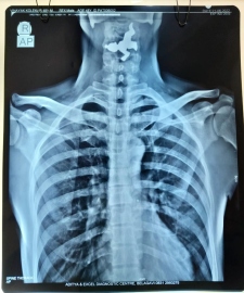 KLES remove brass idol from patient’s neck