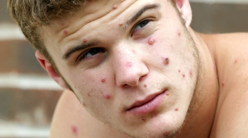 Monkeypox vs Chickenpox: Key differences