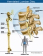 Sciatica uncovered